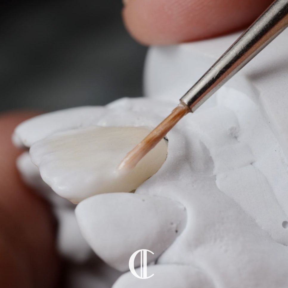 When One-Day Veneers Are Needed and Why Teeth Turn Yellow | Dogok-dong Dental Clinic image 11