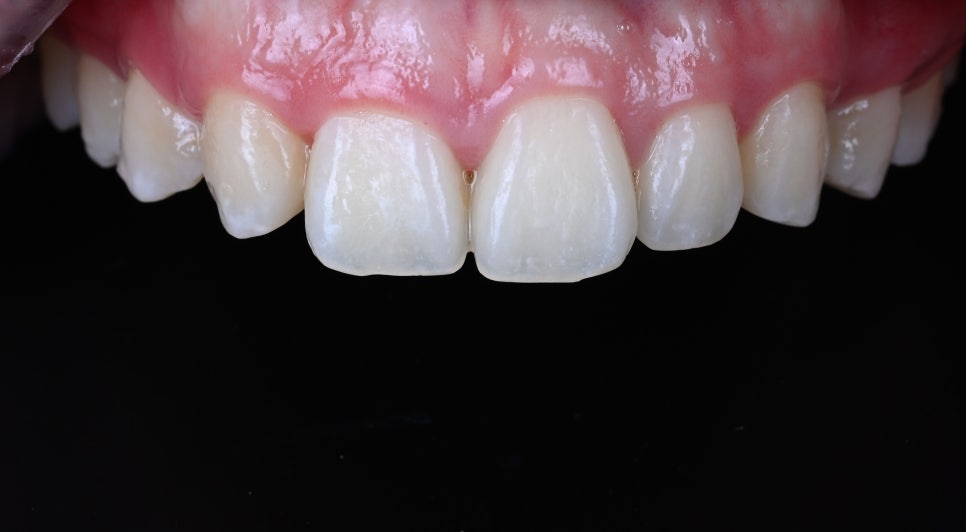 Real Review - The Tooth and Gum Contouring That Surprised Everyone After Seeing the Photos, Without Laminate Veneers image 1