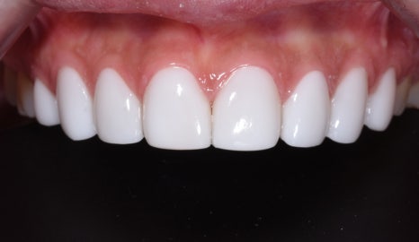 치아 모양이 안예뻐서 속상해요 관련 이미지 2