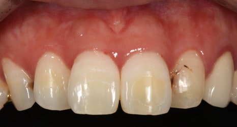 교정은 너무 오래 걸려요. 라미네이트로 빨리 가능할까요? 관련 이미지 2