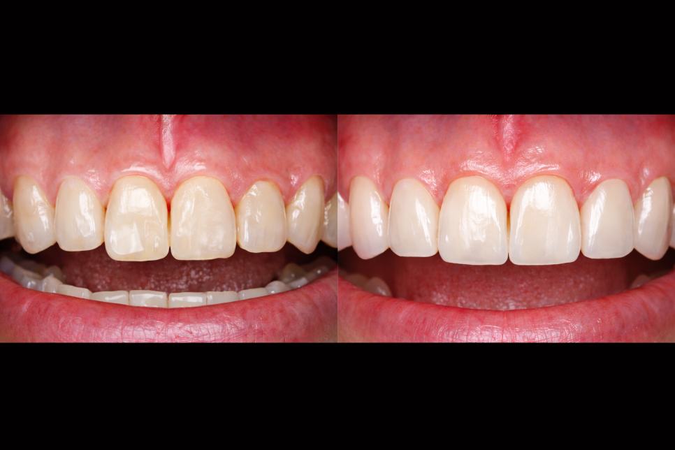 라미네이트 시술, 치아 삭제는 얼마나 할까요? 관련 이미지 1