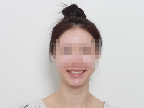 교정은 너무 오래 걸려요. 라미네이트로 빨리 가능할까요? 관련 이미지 6