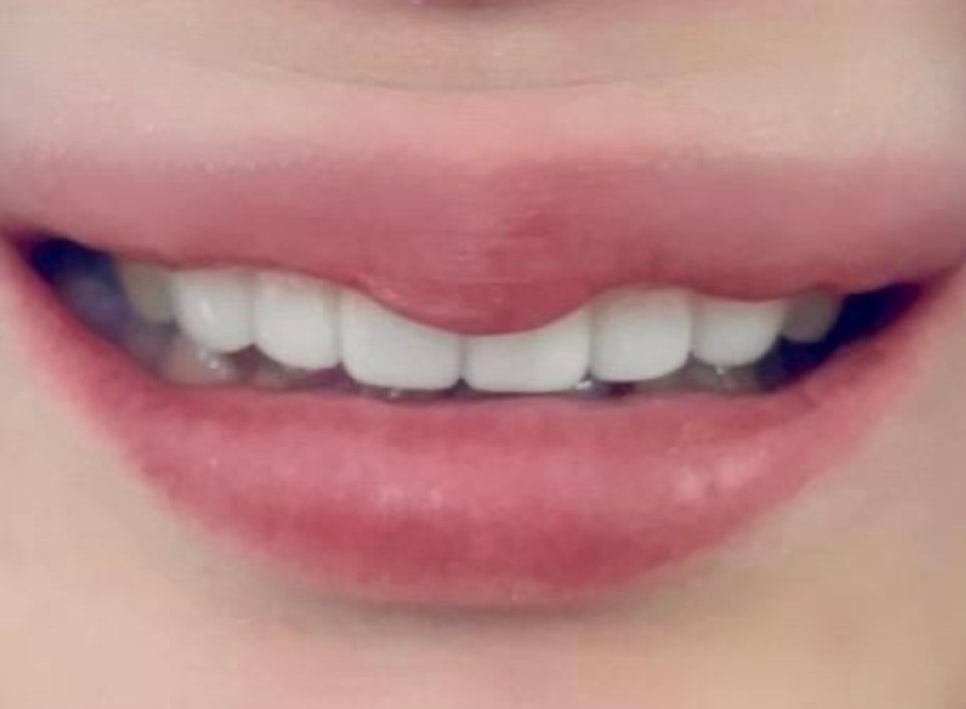 치아교정 3년 대신 선택한 방법 앞니라미네이트|강남 클레어치과 관련 이미지 3