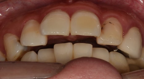 교정은 너무 오래 걸려요. 라미네이트로 빨리 가능할까요? 관련 이미지 1