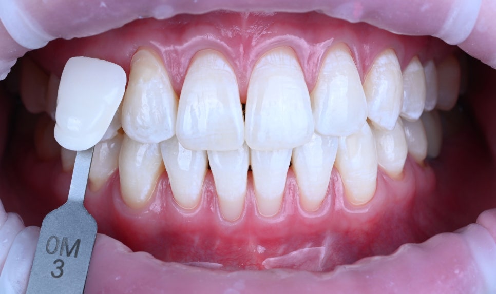 미소 이미지를 위한 심미 관리 관련 이미지 2