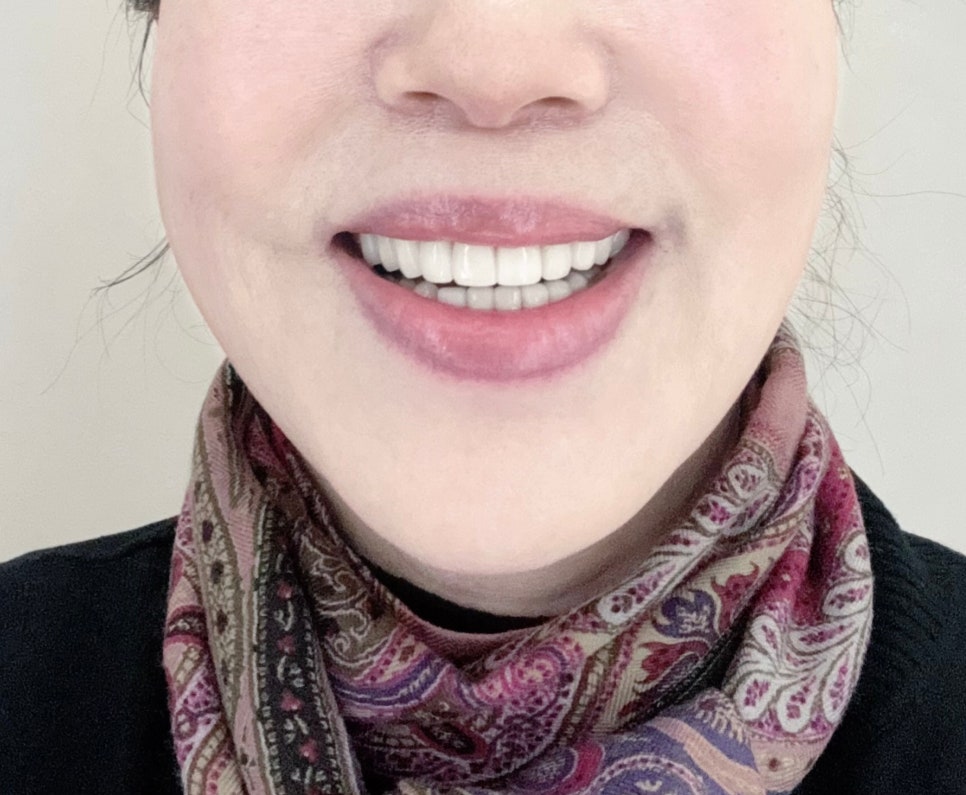 강남치과 중년 안티에이징 치과치료, 64세 라미네이트 후기 관련 이미지 1