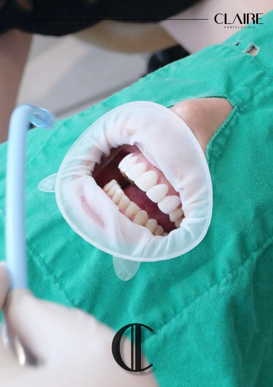 Why Do Coffee and Yellow Teeth Cause Tooth Discoloration at a Hannam-dong Dental Clinic? image 8
