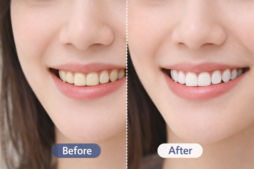 부담 없이 고려해볼 수 있는 심미 치료 관련 이미지 1