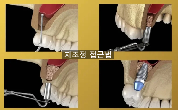 선릉잘하는 치과 상악동 거상술 비용 관련 이미지 2