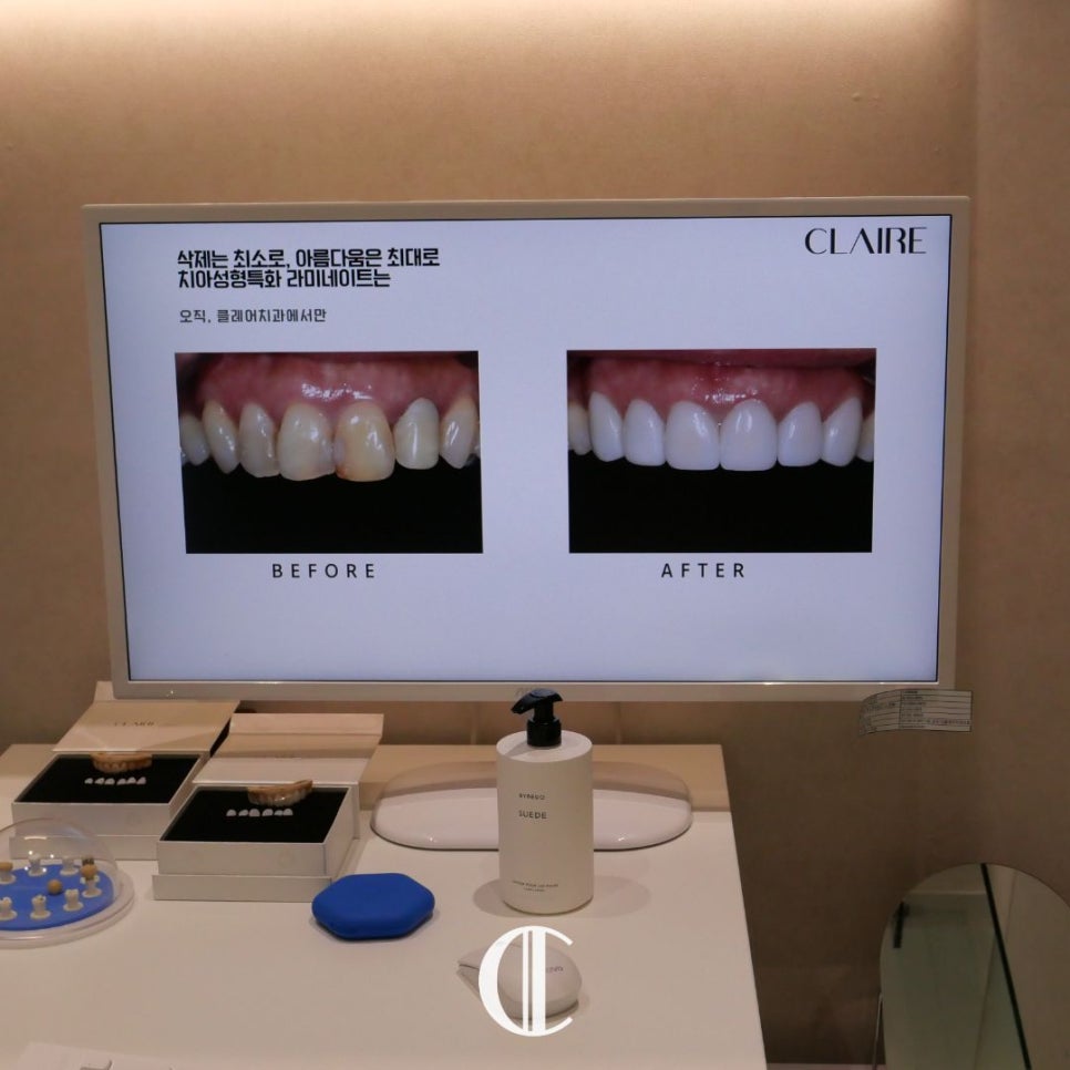 Lami Dental Clinic Gangnam: How to Whiten Yellow Teeth with Small Teeth and Yellow Dentin? image 7