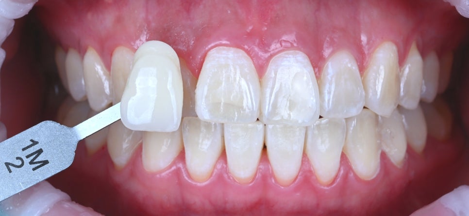 치아 착색 관리의 한 방법 관련 이미지 2