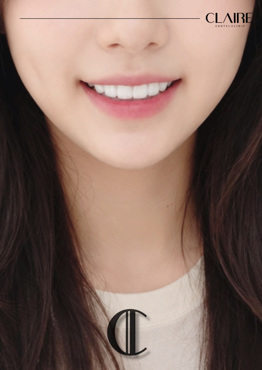 Why Do Coffee and Yellow Teeth Cause Tooth Discoloration at a Hannam-dong Dental Clinic? image 15
