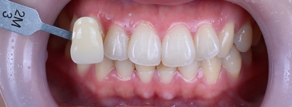 대치동 치아미백, 치과에서 하는 미백이 다른 이유 관련 이미지 1