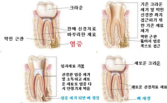 신경치료잘하는 치과, 재신경치료란 무엇인가? 관련 이미지 1