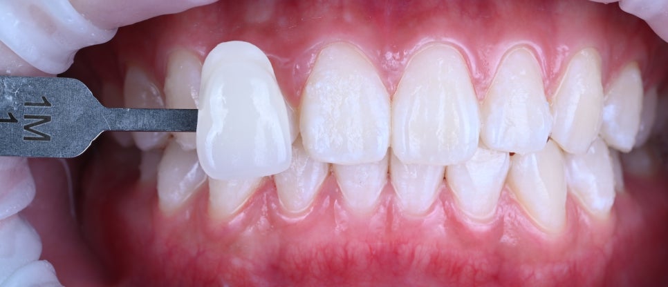 강남치아미백, 치아 색만 정리했을 뿐인데 인상이 달라졌습니다 | 선릉치아미백 관련 이미지 2