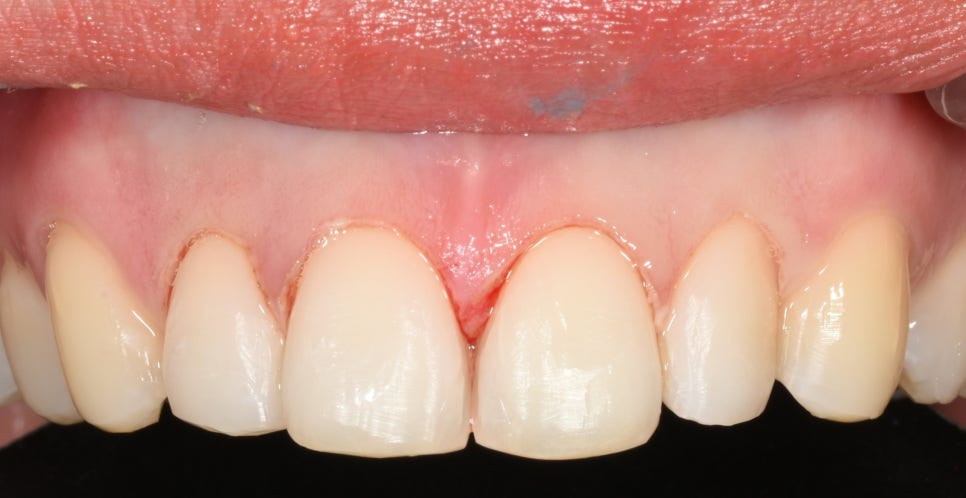 라미네이트는 정말 삭제를 많이 해야할까? 관련 이미지 2