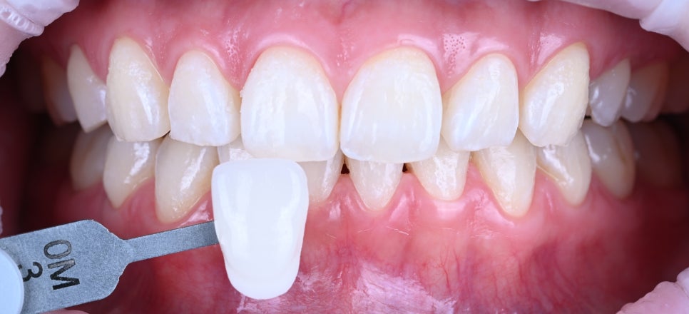 강남치아미백치과| 미백을 고민하고 있다면 먼저 확인해야 할 것 관련 이미지 2