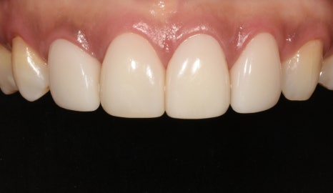 &ldquo;치아 비대칭, 교정 말고 라미네이트로 잡을 수 있을까?&rdquo; 관련 이미지 3