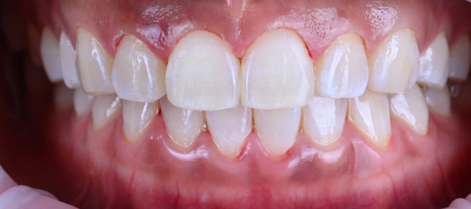 웃을 때 잇몸이 많이 보인다면? 잇몸성형 전후로 달라진 미소｜전치부 심미 레이저 시술일지 관련 이미지 1