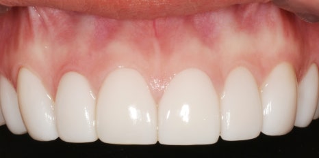 라미네이트는 정말 삭제를 많이 해야할까? 관련 이미지 4