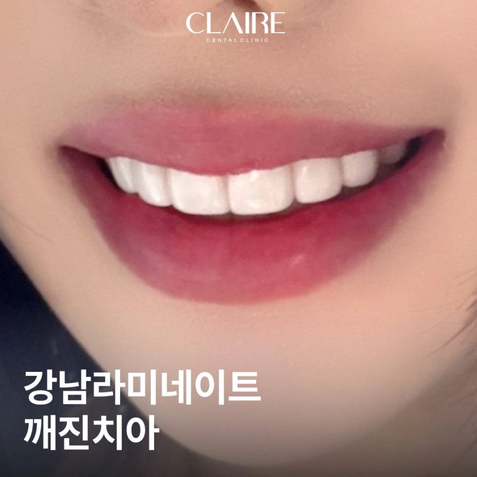 깨진 치아 이가 깨졌을때 예쁘게 복원 가능할까? 관련 이미지 1
