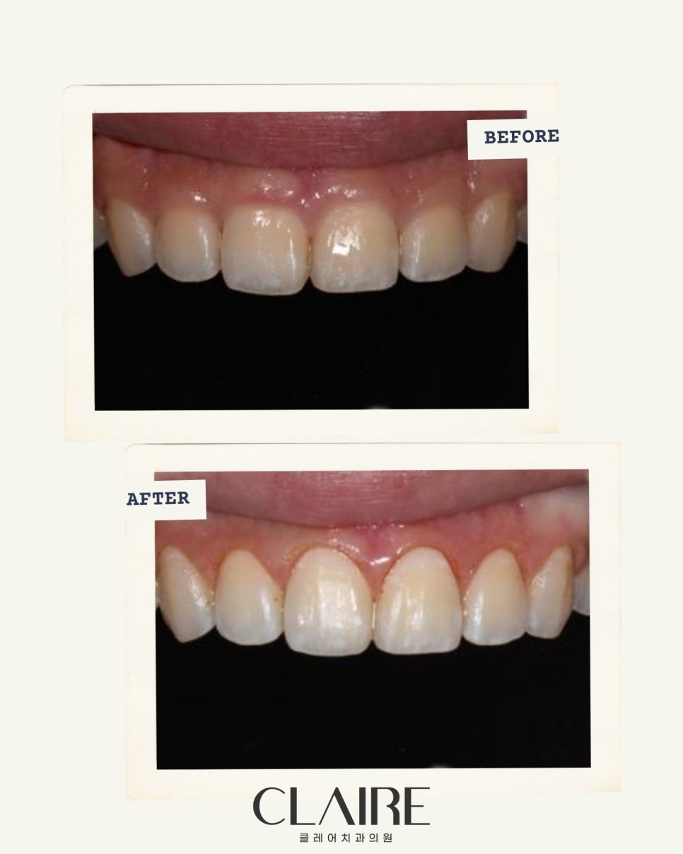 잇몸 성형만으로도 라미네이트 효과가 나나요? 관련 이미지 1
