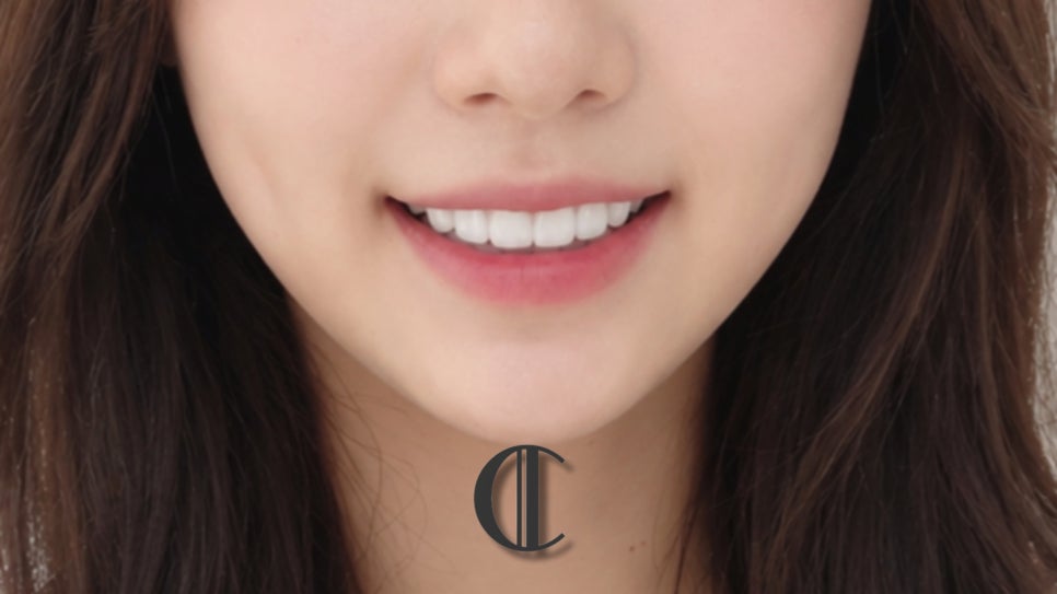 거미스마일 잇몸돌출교정 꼭 알아야 할 선택법 대치역 치과 관련 이미지 12