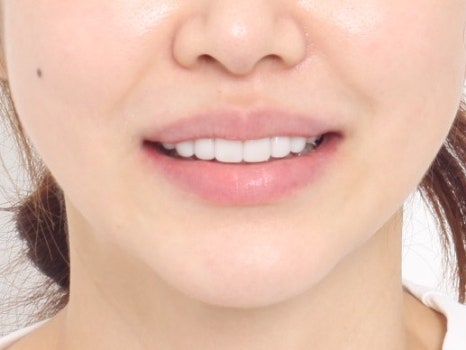 치아성형 라미네이트가 뭐에요? 무삭제 라미네이트가 좋은거 아닌가요? 관련 이미지 5