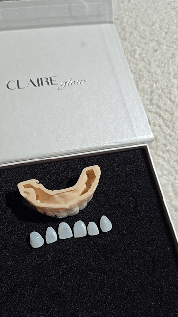 Eonju Station Dental Clinic: For Laminate Veneer Retreatment, Do the Teeth Have to Be Filed Down Again? image 2