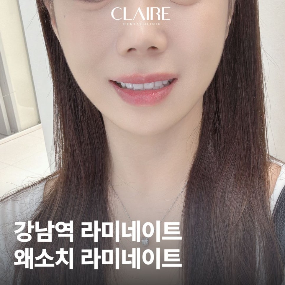 Lami Dental Clinic Gangnam: How to Whiten Yellow Teeth with Small Teeth and Yellow Dentin? image 1