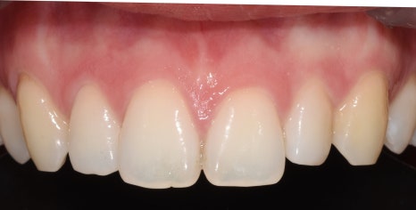 라미네이트는 정말 삭제를 많이 해야할까? 관련 이미지 3