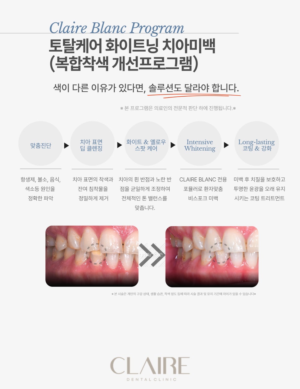 미백후기 좋은 치과 찾는다면? 치아미백 전 꼭 알아야 할 3가지 관련 이미지 1