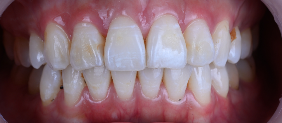 치아교정 3년 대신 선택한 방법 앞니라미네이트|강남 클레어치과 관련 이미지 1