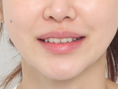 치아성형 라미네이트가 뭐에요? 무삭제 라미네이트가 좋은거 아닌가요? 관련 이미지 4