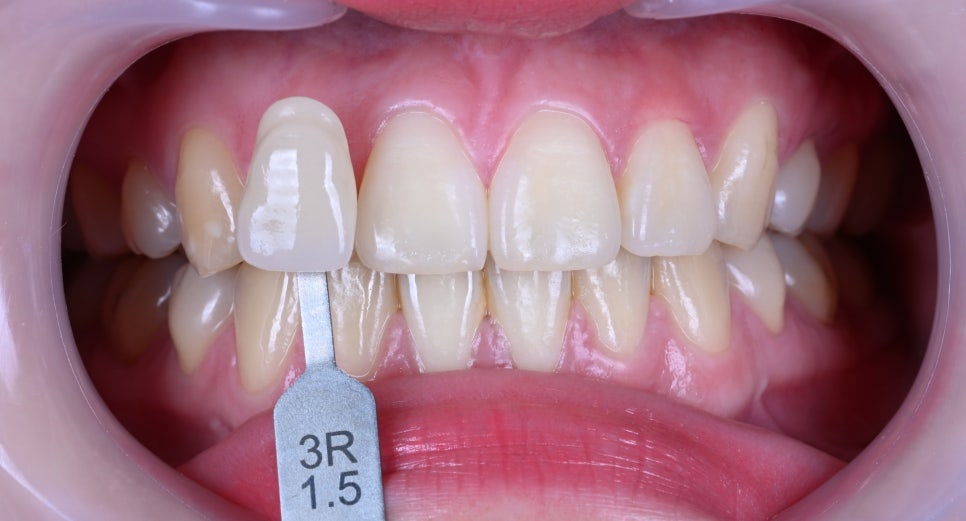 치아미백 리얼 기록 &ndash; 원데이 2회 미백으로 바뀐 치아 톤 관련 이미지 1