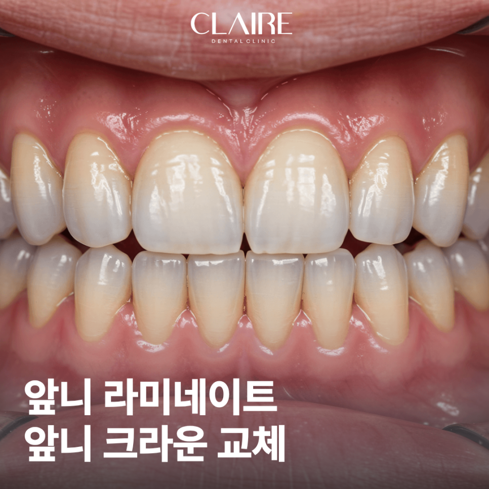앞니 크라운 교체 가격 강남 무삭제 라미네이트 치과 선택은? 관련 이미지 1