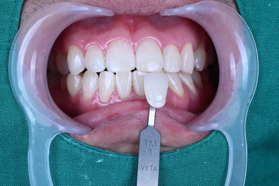 강남치아미백, 선릉치아미백 리얼 후기 관련 이미지 2