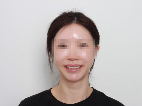 교정은 너무 오래 걸려요. 라미네이트로 빨리 가능할까요? 관련 이미지 7