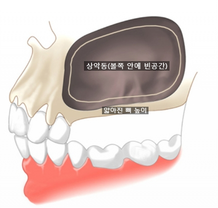 선릉잘하는 치과 상악동 거상술 비용 관련 이미지 1