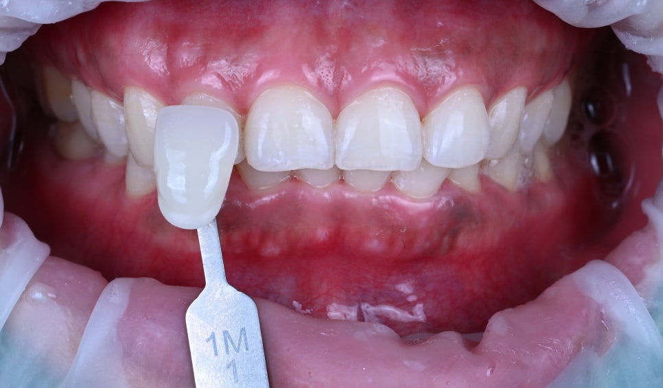 선릉치아미백치과| 부담 없이 시작할 수 있는 심미 치료 관련 이미지 2