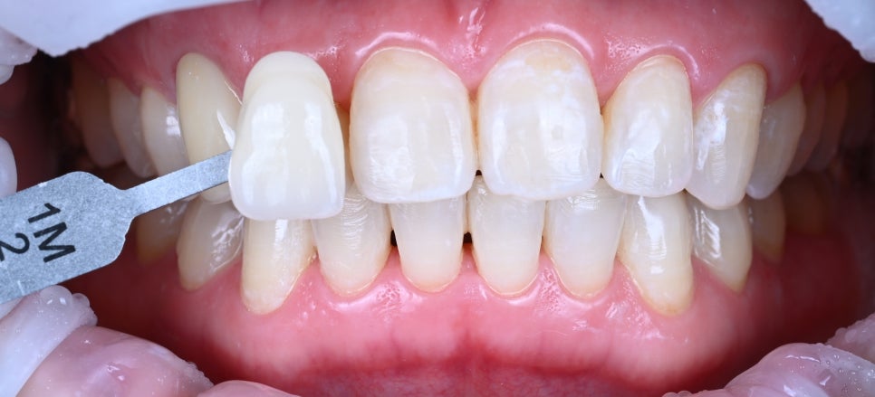 치아 색이 정리되면 인상이 훨씬 깔끔해집니다 관련 이미지 2