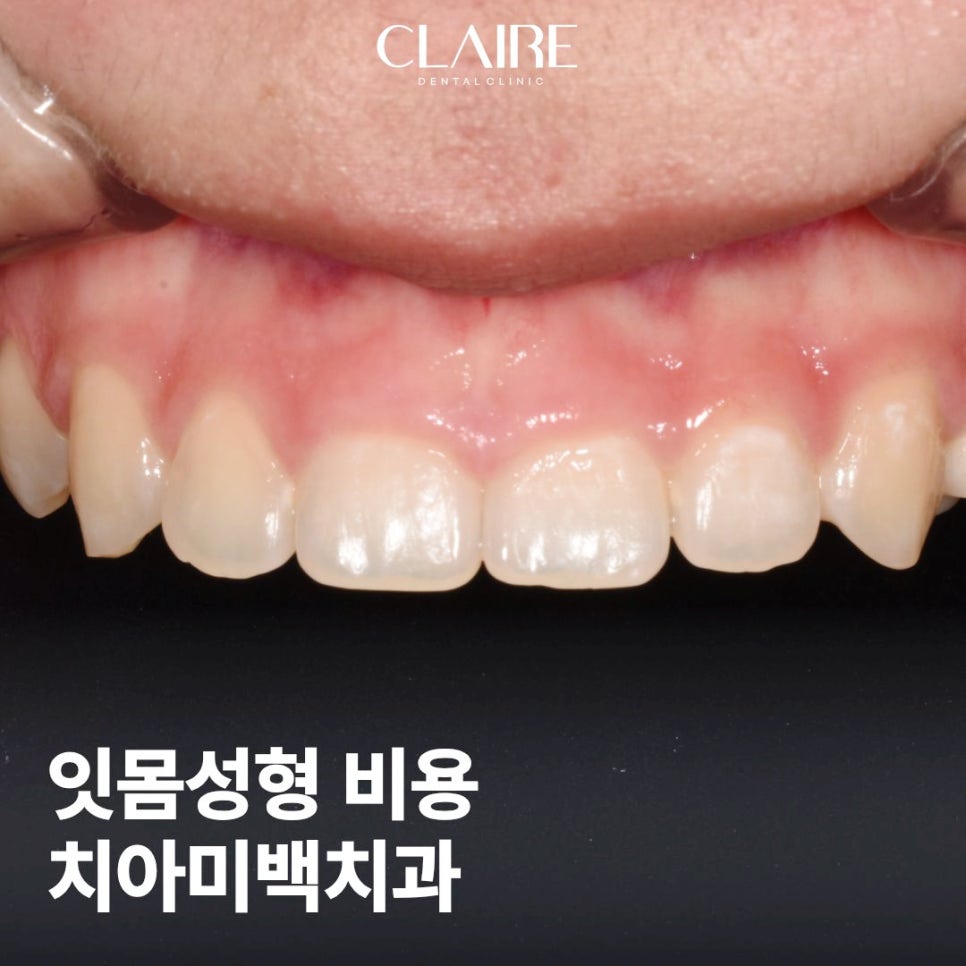 잇몸성형 후기 비용 치아미백치과 미소가 고민이라면? 관련 이미지 1