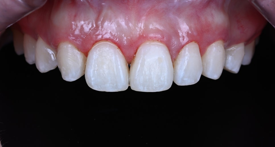 Real Review - The Tooth and Gum Contouring That Surprised Everyone After Seeing the Photos, Without Laminate Veneers image 2