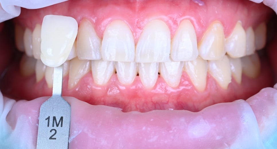 강남 치아미백 효과 차이가 나는 이유| 클레어치과 관련 이미지 1