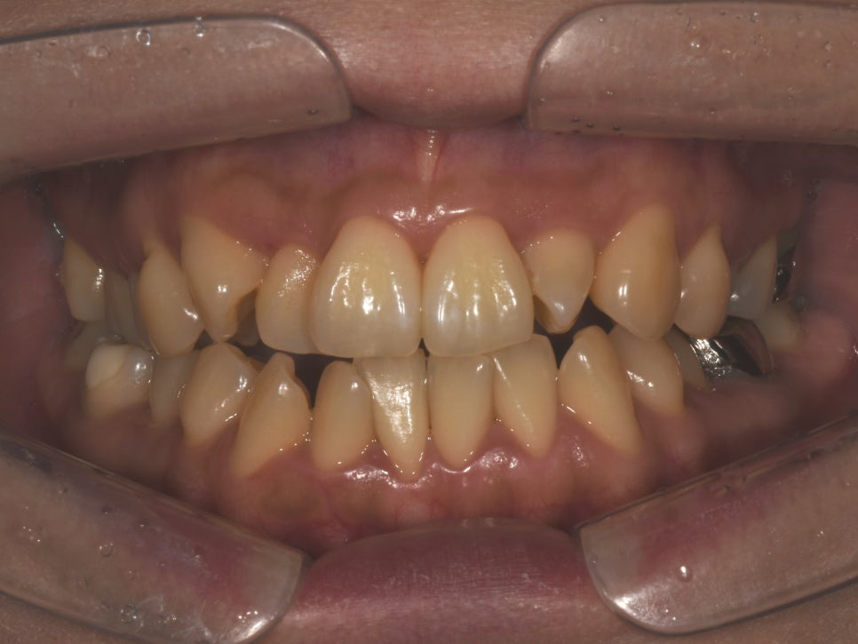 치아교정 3년 대신 선택한 방법 앞니라미네이트|강남 클레어치과 관련 이미지 2