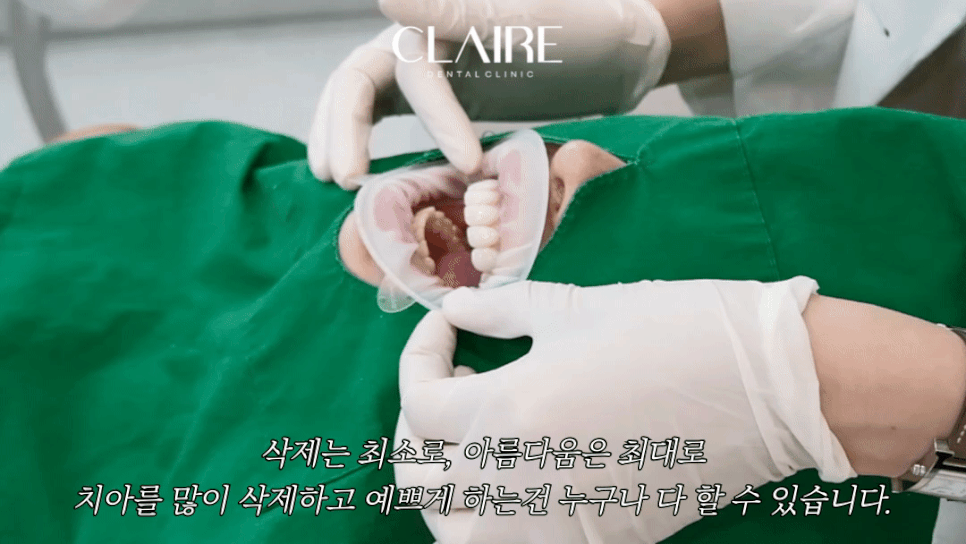 벌어진 앞니 교정 나비치아 라미네이트 가능할까? <클레어치과의원> 관련 이미지 2