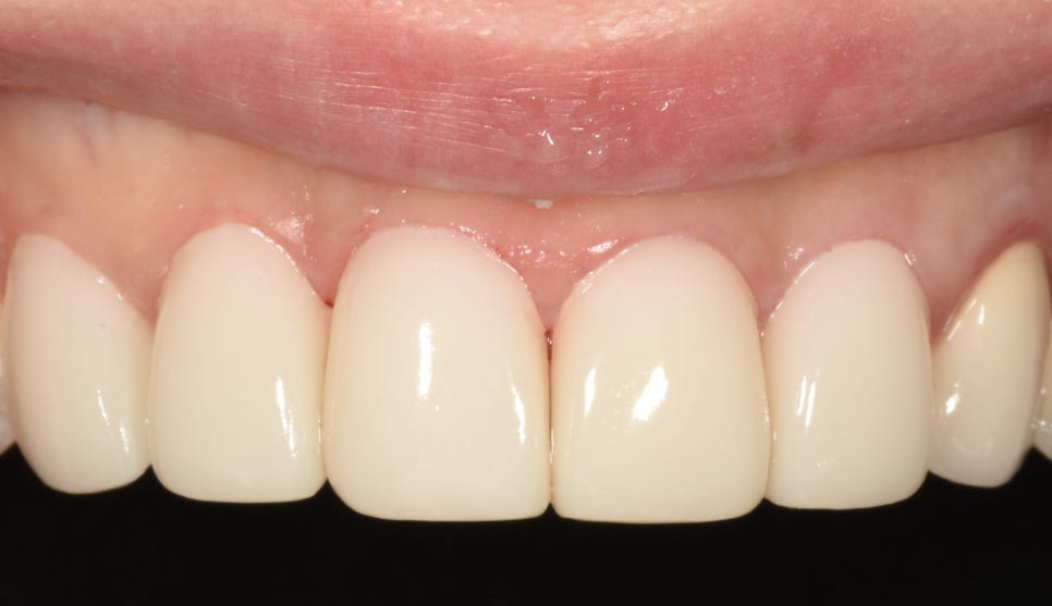 교정은 너무 오래 걸려요. 라미네이트로 빨리 가능할까요? 관련 이미지 5