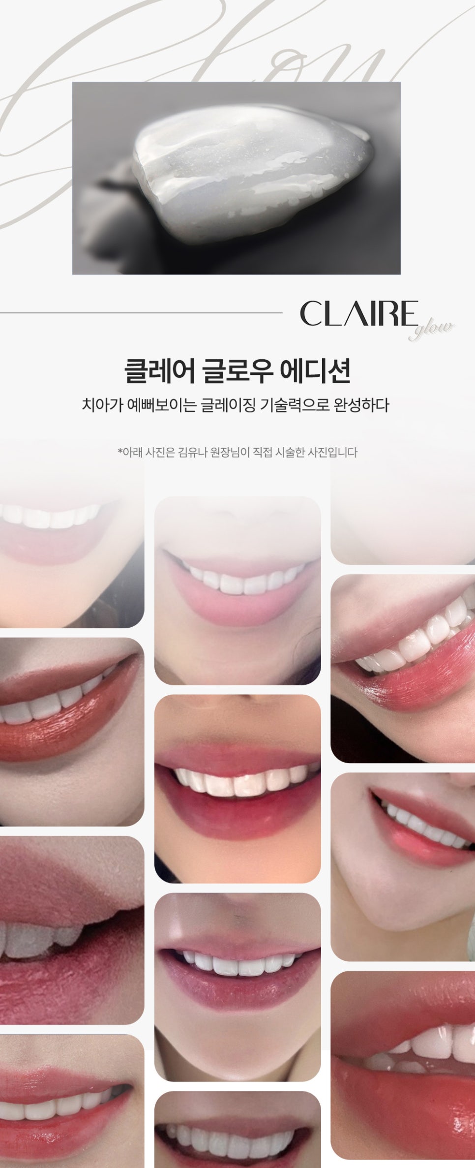 자연치 보존을 위해 무삭제 라미네이트, 치아성형 라미네이트 뭐가 좋을까? 관련 이미지 2