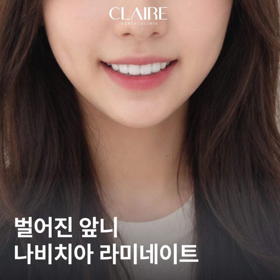 벌어진 앞니 교정 나비치아 라미네이트 가능할까? <클레어치과의원> 관련 이미지 1