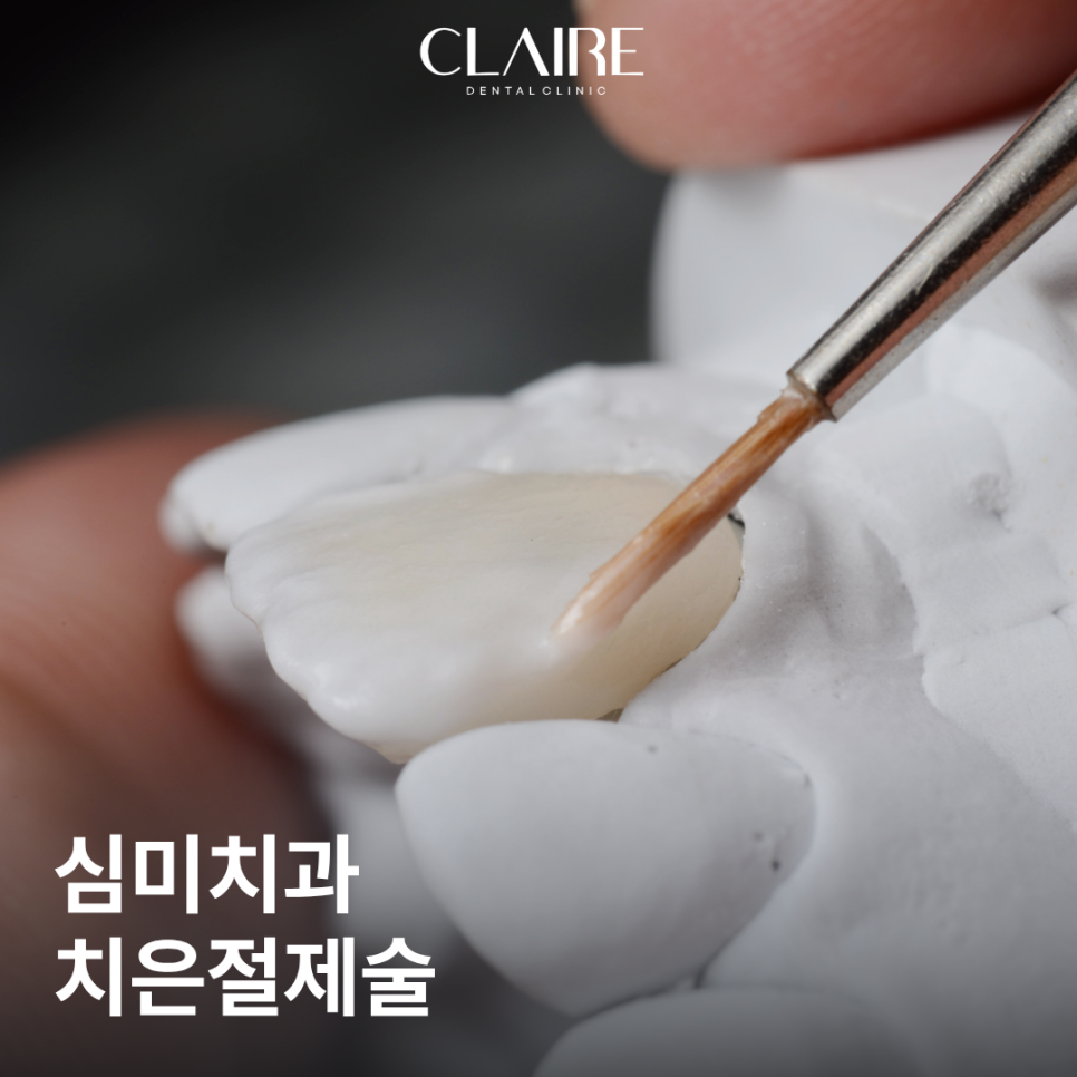거미스마일 잇몸돌출교정 꼭 알아야 할 선택법 대치역 치과 관련 이미지 1